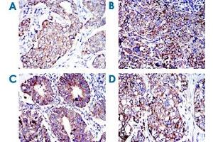 Immunohistochemical analysis of paraffin-embedded human breast cancer (A), human cervical cancer (B), human rectum cancer (C) and human lung cancer (D) tissues using AIFM1 monoclonal antibody, clone 4E7  with DAB staining.