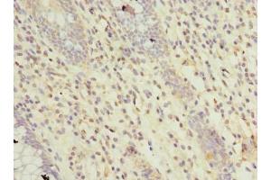 Immunohistochemistry of paraffin-embedded human colon cancer using ABIN7167492 at dilution of 1:100 (RTP4 抗体  (AA 1-224))