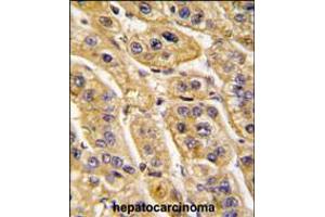 Formalin-fixed and paraffin-embedded human hepatocarcinoma tissue reacted with HIBCH antibody , which was peroxidase-conjugated to the secondary antibody, followed by DAB staining. (HIBCH 抗体  (AA 183-209))