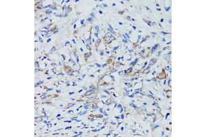 Immunohistochemistry of paraffin-embedded human uterine cancer using USO1 antibody (ABIN1875291) at dilution of 1:100 (40x lens). (USO1 抗体)