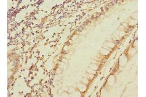 Immunohistochemistry of paraffin-embedded human colon cancer using ABIN7160425 at dilution of 1:100 (MPZL2 抗体  (AA 30-140))