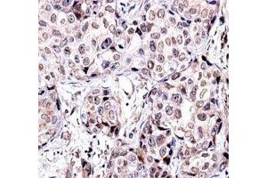 SIRT6 antibody immunohistochemistry analysis in formalin fixed and paraffin embedded human breast carcinoma. (SIRT6 抗体  (AA 276-305))