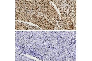 CTCF antibody (pAb) tested by Immunohistochemistry Nuclear staining pattern is detected in Formalin-fixed, paraffin-embedded tissue sections from human breast carcinoma. (CTCF 抗体  (N-Term))