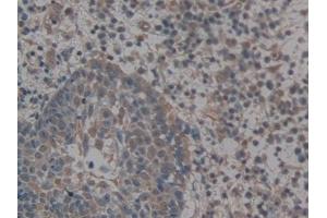 Detection of GLG1 in Human Skin cancer Tissue using Polyclonal Antibody to Golgi Glycoprotein 1 (GLG1) (GLG1 抗体  (AA 1048-1145))