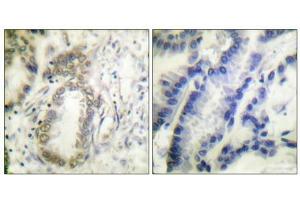 Immunohistochemical analysis of paraffin-embedded human colon carcinoma tissue using C/EBP-α (phospho-Ser21) antibody (left)or the same antibody preincubated with blocking peptide (right). (CEBPA 抗体  (pSer21))