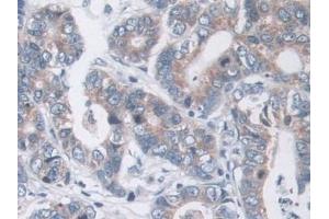 Detection of MOSC1 in Human Stomach cancer Tissue using Polyclonal Antibody to MOCO Sulphurase C-Terminal Domain Containing Protein 1 (MOSC1)