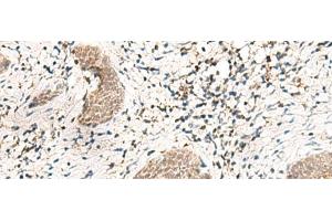 Immunohistochemistry of paraffin-embedded Human esophagus cancer tissue using SNRPG Polyclonal Antibody at dilution of 1:40(x200) (SNRPG 抗体)