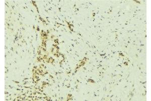 ABIN6277007 at 1/100 staining Human breast cancer tissue by IHC-P. (SMARCA5 抗体  (C-Term))