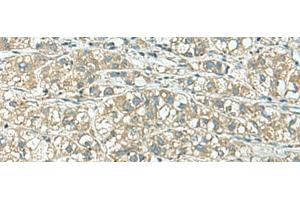 Immunohistochemistry of paraffin-embedded Human liver cancer tissue using KCNJ2 Polyclonal Antibody at dilution of 1:25(x200) (KCNJ2 抗体)