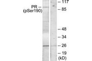 Immunohistochemistry analysis of paraffin-embedded human breast carcinoma, using Progesterone Receptor (Phospho-Ser190) Antibody. (Progesterone Receptor 抗体  (pSer190))