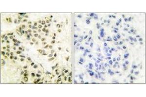 Immunohistochemistry analysis of paraffin-embedded human breast carcinoma tissue, using DNA-PK Antibody. (PRKDC 抗体  (AA 4061-4110))