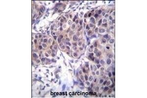 DVL3 Antibody (C-term) (ABIN655969 and ABIN2845354) immunohistochemistry analysis in formalin fixed and paraffin embedded human breast carcinoma followed by peroxidase conjugation of the secondary antibody and DAB staining. (DVL3 抗体  (C-Term))