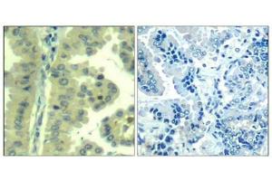 Immunohistochemical analysis of paraffin-embedded human lung carcinoma tissue using eIF4G(Ab-1232) Antibody(left) or the same antibody preincubated with blocking peptide(right). (EIF4G1 抗体)