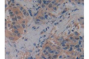 IHC-P analysis of Human Breast cancer Tissue, with DAB staining.