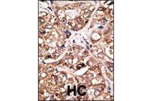 Formalin-fixed and paraffin-embedded human cancer tissue reacted with the primary antibody, which was peroxidase-conjugated to the secondary antibody, followed by DAB staining. (NEUROD1 抗体  (N-Term))