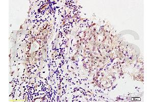 Formalin-fixed and human breast carcinoma tissue labeled with Anti-MMS19 Polyclonal Antibody, Unconjugated (ABIN1387802) at 1:200 followed by conjugation to the secondary antibody and DAB staining (MMS19 抗体  (AA 851-950))