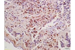 Formalin-fixed and paraffin embedded human colon carcinoma labeled with Anti-Cyclin B1 Polyclonal Antibody, Unconjugated (ABIN670296) at 1:200 followed by conjugation to the secondary antibody and DAB staining (Cyclin B1 抗体  (AA 271-433))