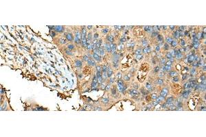 Immunohistochemistry of paraffin-embedded Human colorectal cancer tissue using CEACAM8 Polyclonal Antibody at dilution of 1:30(x200) (CEACAM8 抗体)