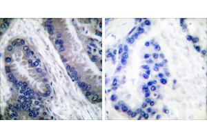 Cl-peptide - +Immunohistochemical analysis of paraffin-embedded human lung carcinoma tissue, using Caspase 1 (Cleaved-Asp210) antibody. (Caspase 1 抗体  (Cleaved-Asp210))