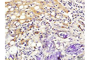 Formalin-fixed and paraffin embedded human colon cancer labeled with Rabbit Anti-Kiss 1/Kisspeptin Polyclonal Antibody (ABIN672726), Unconjugated 1:200 followed by conjugation to the secondary antibody and DAB staining. (KISS1 抗体  (AA 81-145))