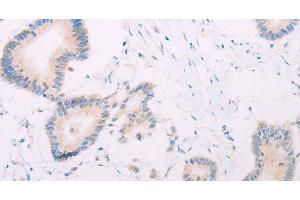 Immunohistochemistry of paraffin-embedded Human colon cancer tissue using MAP3K12 Polyclonal Antibody at dilution 1:30 (MAP3K12 抗体)