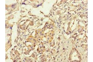 Immunohistochemistry of paraffin-embedded human pancreatic cancer using ABIN7167005 at dilution of 1:100 (KIAA1432 (KIAA1432) (AA 951-1233) 抗体)