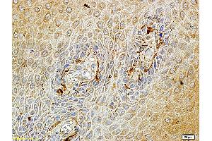 Formalin-fixed and paraffin embedded human endometrium carcinoma labeled with Rabbit Anti-Matriptase Polyclonal Antibody (ABIN669726), Unconjugated at 1:100 followed by conjugation to the secondary antibody and DAB staining. (ST14 抗体  (AA 11-100))
