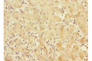 Immunohistochemistry of paraffin-embedded human liver cancer using ABIN7152685 at dilution of 1:100 (FRMD6 抗体  (AA 413-622))