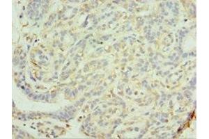 Immunohistochemistry of paraffin-embedded human breast cancer using ABIN7159289 at dilution of 1:100 (MAGEC2 抗体  (AA 1-150))