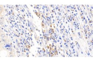 Detection of DPP3 in Human Lymphoma Tissue using Polyclonal Antibody to Dipeptidyl Peptidase 3 (DPP3) (DPP3 抗体  (AA 2-261))
