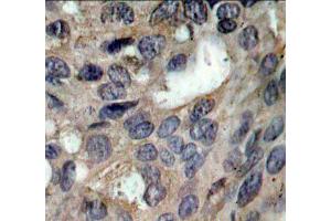 Immunohistochemistry of paraffin-embedded human breast carcinoma using Phospho-SRC-Y529 antibody (ABIN5969948). (Src 抗体  (pTyr529))