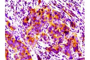 IHC image of ABIN7165944 diluted at 1:100 and staining in paraffin-embedded human pancreatic cancer performed on a Leica BondTM system. (PPM1F 抗体  (AA 1-76))