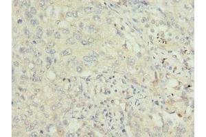 Immunohistochemistry of paraffin-embedded human lung cancer using ABIN7172240 at dilution of 1:100 (TRAF4 抗体  (AA 251-470))