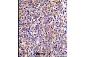 THEMIS Antibody (C-term) (ABIN655135 and ABIN2844761) immunohistochemistry analysis in formalin fixed and paraffin embedded human thymoma followed by peroxidase conjugation of the secondary antibody and DAB staining. (THEMIS 抗体  (C-Term))