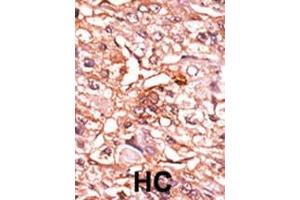 Formalin-fixed and paraffin-embedded human cancer tissue reacted with the primary antibody, which was peroxidase-conjugated to the secondary antibody, followed by AEC staining. (CDC25B 抗体  (pSer353))