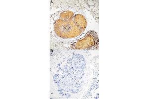 Immunohistochemical staining of human breast cancer tissue by Fadd (phospho S190) polyclonal antibody  without blocking peptide (A) or preincubated with blocking peptide (B) under 1:50-1:100 dilution. (FADD 抗体  (pSer190))