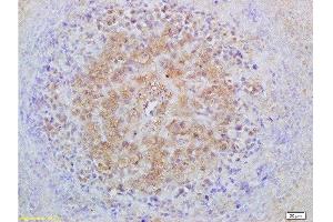 Formalin-fixed and paraffin embedded mouse lymphoma labeled with Anti-Smad3 Polyclonal Antibody, Unconjugated  at 1:200 followed by conjugation to the secondary antibody and DAB staining (Smad2/3 抗体  (AA 30-80))