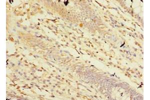 Immunohistochemistry of paraffin-embedded human colon cancer using ABIN7146760 at dilution of 1:100 (Carboxypeptidase A2 抗体  (AA 115-419))