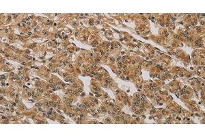 Immunohistochemistry of paraffin-embedded Human prostate cancer using BRAF Polyclonal Antibody at dilution of 1:30 (BRAF 抗体)