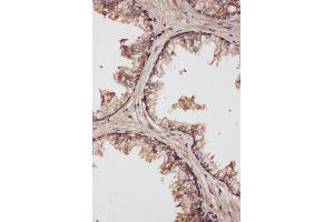 Anti-LCN1 antibody,IHC(P) IHC(P): Human Prostatic Cancer Tissue (Lipocalin 1 抗体  (Middle Region))