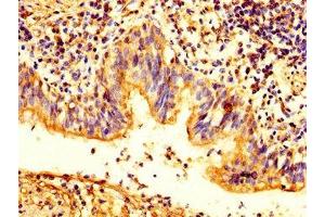 IHC image of ABIN7163503 diluted at 1:200 and staining in paraffin-embedded human lung cancer performed on a Leica BondTM system. (Plakophilin 2 抗体  (AA 61-183))