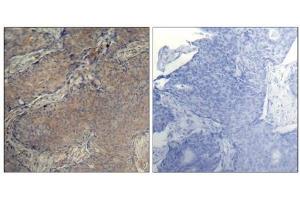 Immunohistochemical analysis of paraffin-embedded human breast carcinoma tissue using Myosin Light Chain 2 (Phospho-Ser19) Antibody (left) or the same antibody preincubated with blocking peptide (right). (MYL9 抗体  (pSer19))