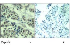 Immunohistochemical analysis of paraffin-embedded human breast carcinoma tissue using MDM2 polyclonal antibody . (MDM2 抗体  (Ser166))