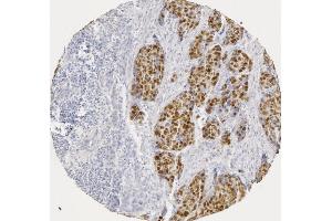 p53 staining in human squamous cell carcinoma (image courtesy of J. (p53 抗体  (AA 20-31))