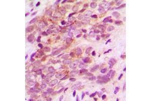 Immunohistochemical analysis of MAGEA9 staining in human breast cancer formalin fixed paraffin embedded tissue section. (MAGEA9 抗体  (N-Term))
