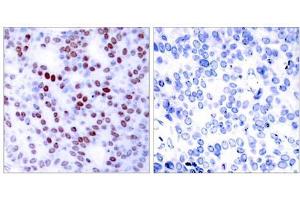 Immunohistochemical analysis of paraffin-embedded human breast carcinoma tissue using c-Jun (Ab-243) antibody (E021025). (C-JUN 抗体)