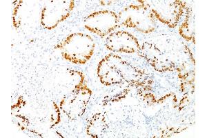Formalin-fixed, paraffin-embedded human Lung Adenocarcinoma stained with TTF-1 Mouse Monoclonal Antibody (8G7G3/1). (NKX2-1 抗体)