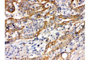 Alpha Actinin 4 was detected in paraffin-embedded sections of human intestinal  cancer tissues using rabbit anti- Alpha Actinin 4 Antigen Affinity purified polyclonal antibody (Catalog # ) at 1 µg/mL. (alpha Actinin 4 抗体  (AA 561-661))