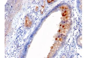 Formalin-fixed, paraffin-embedded human Gastric Carcinoma stained with MUC4 Mouse Monoclonal Antibody (MUC4/3084).