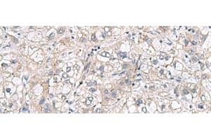 Immunohistochemistry of paraffin-embedded Human liver cancer tissue using RNF208 Polyclonal Antibody at dilution of 1:65(x200) (RNF208 抗体)